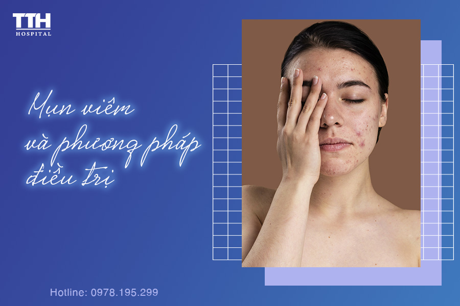 MỤN VIÊM LÀ GÌ? PHƯƠNG PHÁP ĐIỀU TRỊ THẾ NÀO?
